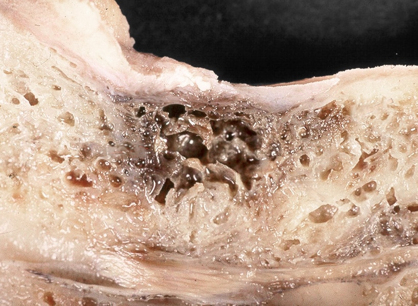 Kawitacja Kawitacja (NICO - neuralgia-inducing cavitational osteonecrosis) to tłuszczowa martwicza zmiana w kości, która może być ogniskiem zapalnym.